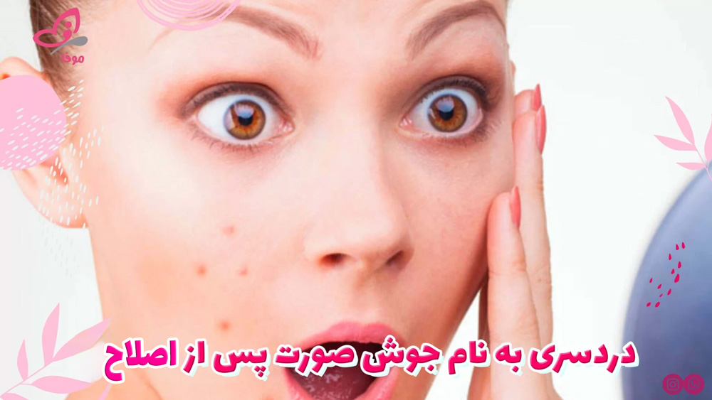 جوش صورت