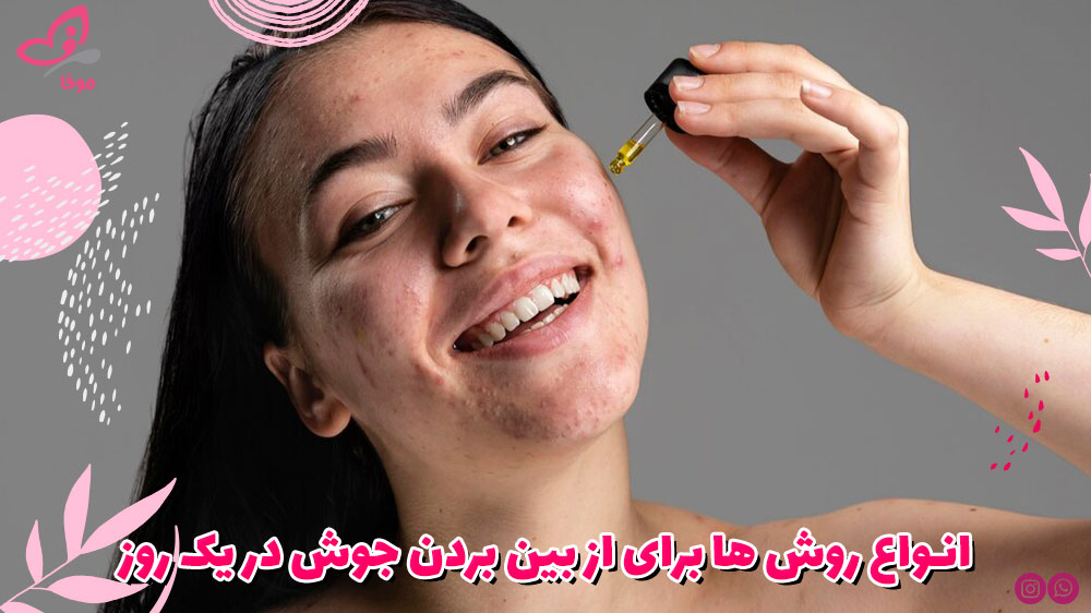 انواع روش ها برای از بین بردن جوش در یک روز