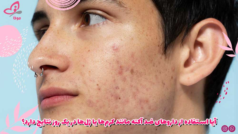آیا استفاده از داروهای ضد آکنه مانند کرمها یا ژلها در یک روز نتایج دارد؟