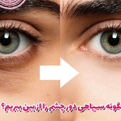 چگونه سیاهی دور چشم را از بین ببریم؟